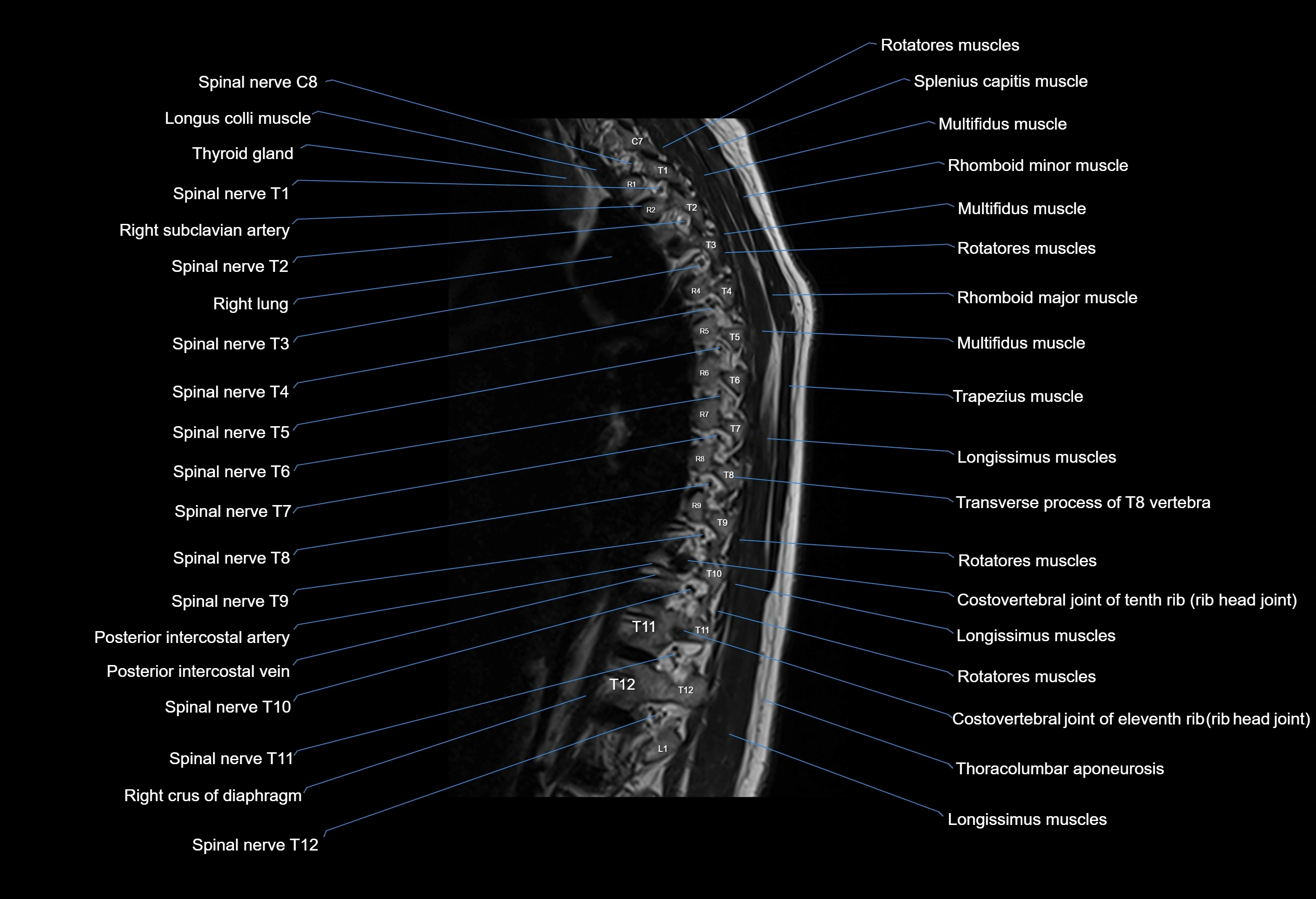 MRI thoracic spine sagittal  cross sectional anatomy 3T radiology  image-img-00001-00005.webp